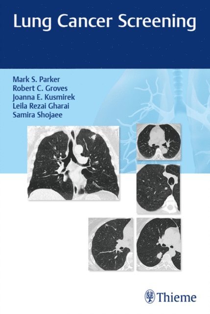 Samira Shojaee, Leila  Rezai Gharai, Joanna Kusmirek, Robert Groves, Mark Parker - Lung Cancer Screening, E-bok