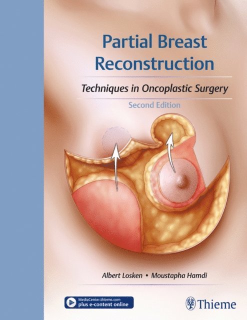 Moustapha Hamdi, Albert Losken - Partial Breast Reconstruction, E-bok