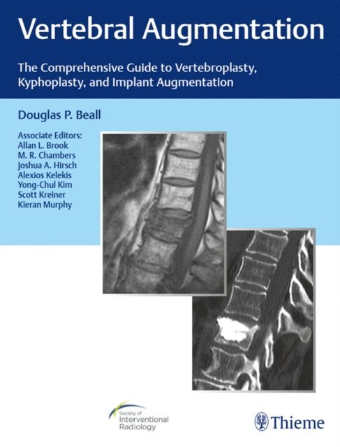 Douglas P. Beall - Vertebral Augmentation, E-bok