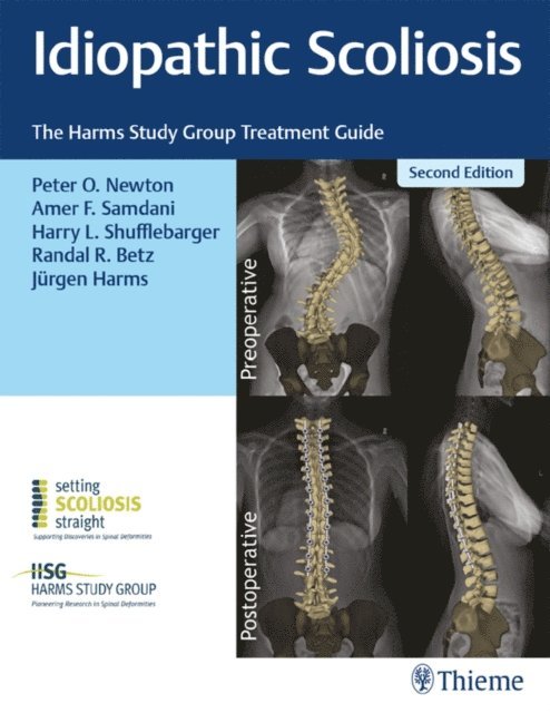 Jurgen Harms, Randal R. Betz, Harry L. Shufflebarger, Amer F. Samdani, Peter O. Newton - Idiopathic Scoliosis, E-bok