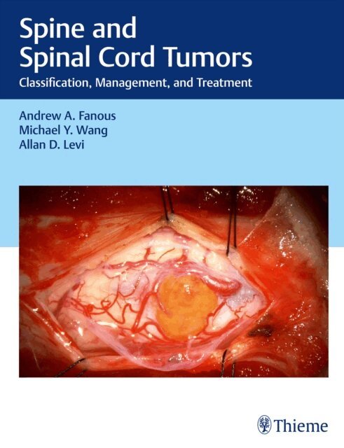 Allan D. Levi, Michael Y. Wang, Andrew Fanous - Spine and Spinal Cord Tumors, E-bok