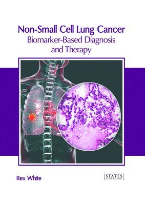 Rex White - Non-Small Cell Lung Cancer: Biomarker-Based Diagnosis and Therapy, Inbunden. Tillgänglighet: Kommande
