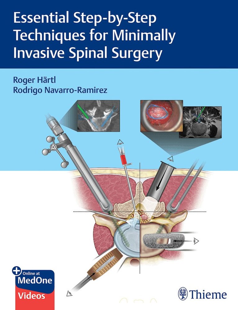 Roger Hartl, Rodrigo Navarro-Ramirez - Essential Step-by-Step Techniques for Minimally Invasive Spinal Surgery, Inbunden