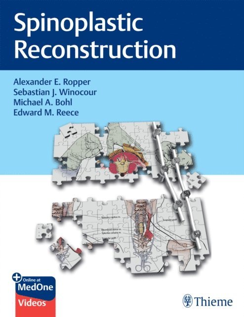 Edward M Reece, Michael A Bohl, Sebastian J. Winocour, Alexander E. Ropper - Spinoplastic Reconstruction, E-bok