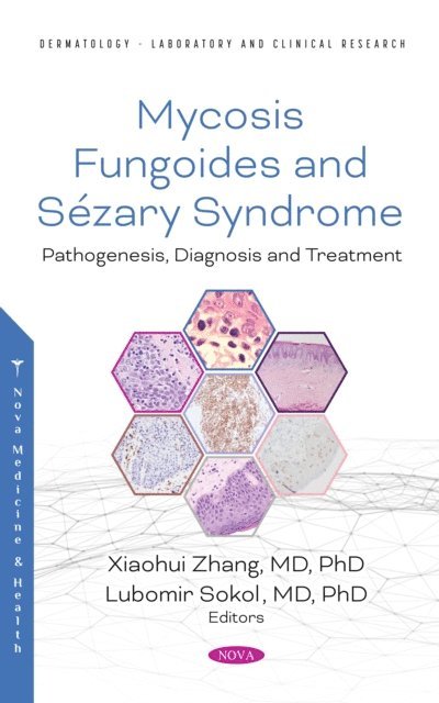 Xiaohui Zhang - Mycosis Fungoides: Causes, Diagnosis and Treatment, E-bok