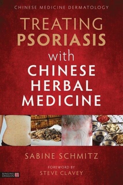 Sabine Schmitz - Treating Psoriasis with Chinese Herbal Medicine (Revised Edition), E-bok