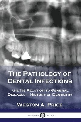 Weston a. Price - Pathology of Dental Infections, Häftad