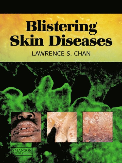 Lawrence Chan - Blistering Skin Diseases, E-bok. Tillgänglighet: Lägg i varukorg