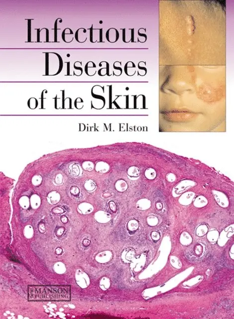 Dirk Elston - Infectious Diseases of the Skin, E-bok. Tillgänglighet: Lägg i varukorg