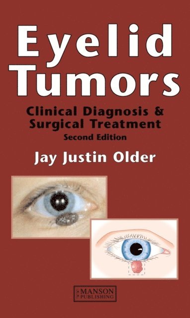 Jay Justin Older - Eyelid Tumors, E-bok