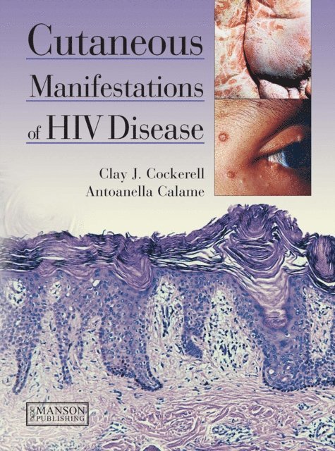 Antoanella Calame, Clay Cockerell - Cutaneous Manifestations of HIV Disease, E-bok