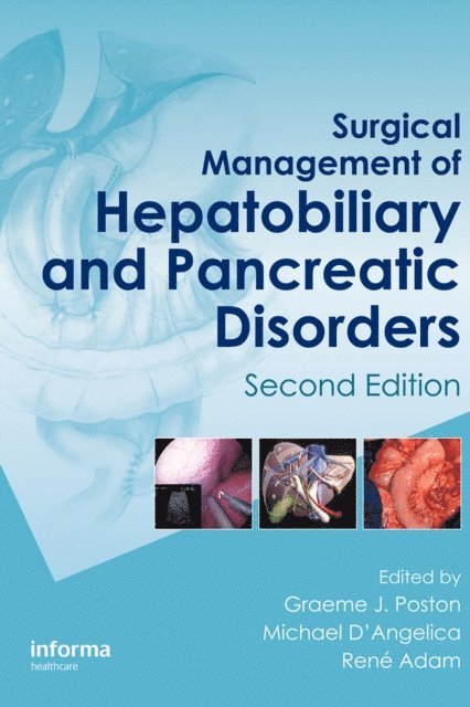 Rene Adam, Michael D'Angelica, Graeme J. Poston - Surgical Management of Hepatobiliary and Pancreatic Disorders, E-bok