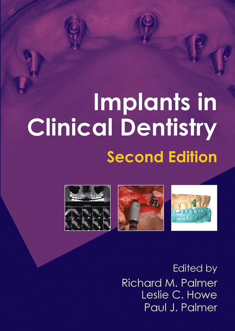Richard M. Palmer, Leslie C. Howe, Paul J. Palmer - Implants in Clinical Dentistry, Inbunden
