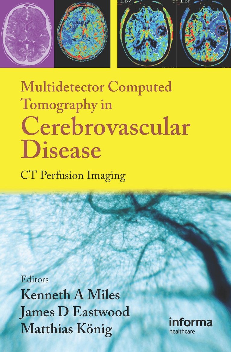 Kenneth Miles, James D. Eastwood, Matthias Konig - Multidetector Computed Tomography in Cerebrovascular Disease, Inbunden