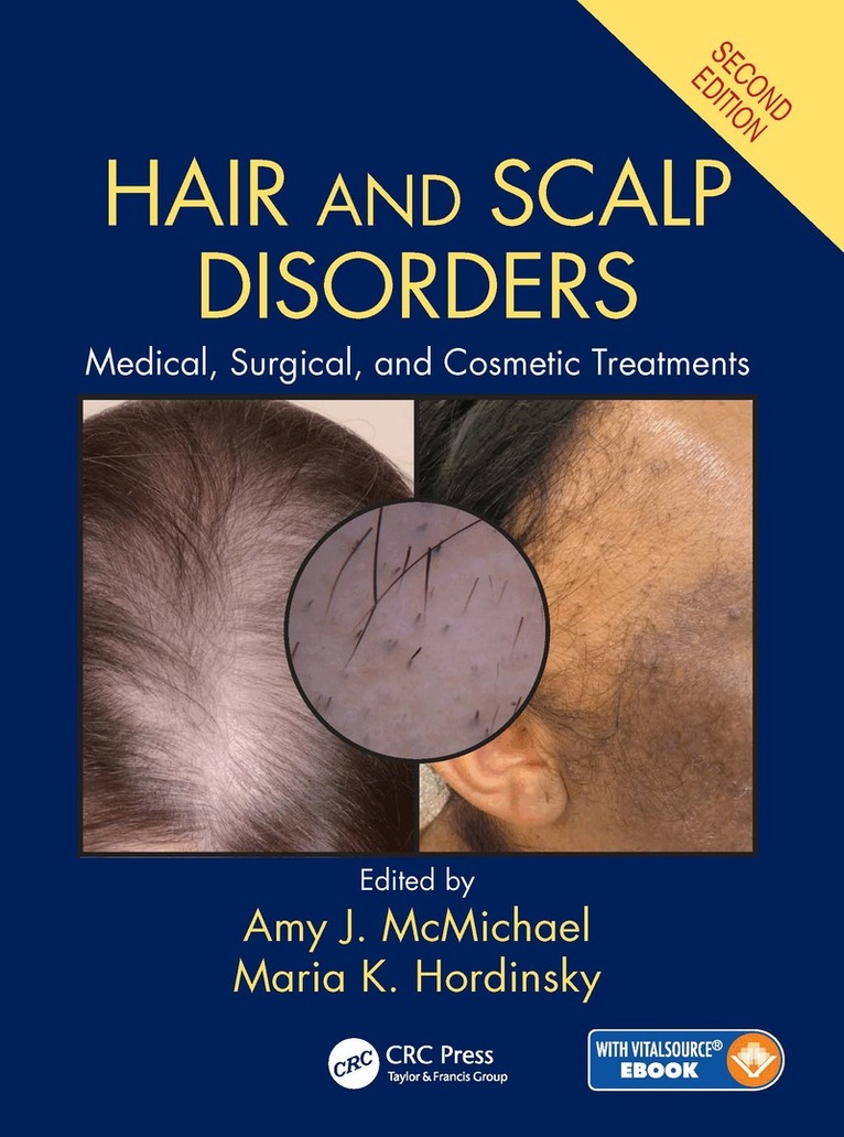 Amy J. McMichael, Maria K. Hordinsky - Hair and Scalp Disorders, Inbunden. Tillgänglighet: Lägg i varukorg