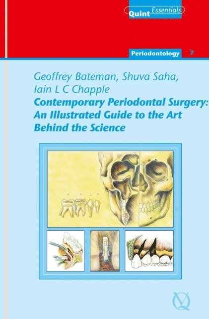 Iain L. C. Chapple, Shuva Saha, Geoffrey Bateman - Contemporary Periodontal Surgery, E-bok