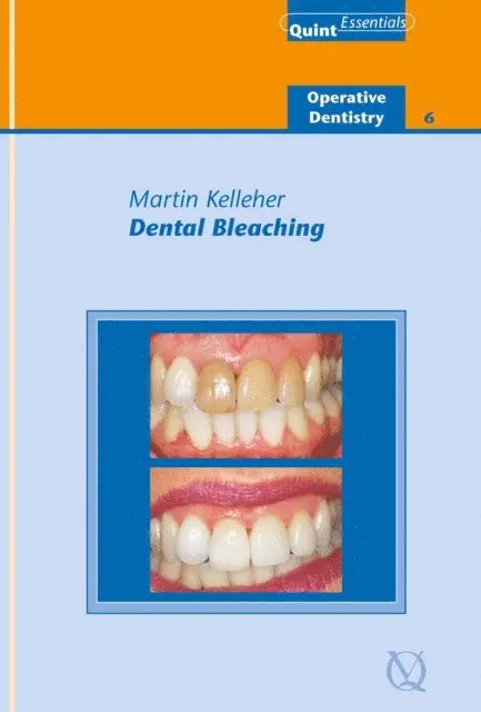 Martin Kelleher - Dental Bleaching, E-bok. Tillgänglighet: Lägg i varukorg
