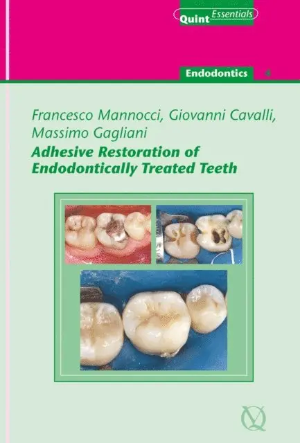 Giovanni Cavalli, Massimo Gagliani, Francesco Mannocci - Adhesive Restoration of Endodontically Treated Teeth, E-bok. Tillgänglighet: Lägg i varukorg