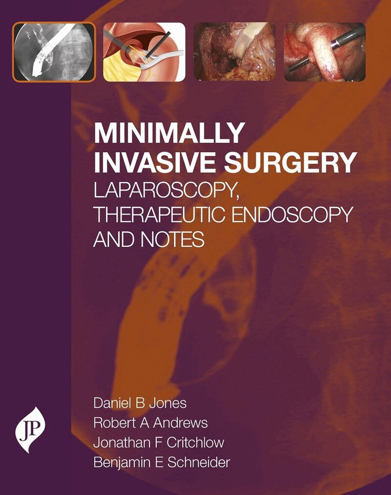 Daniel  B Jones, Robert Andrews, Jonathan F Critchlow, Benjamin E Schneider - Minimally Invasive Surgery, Inbunden. Tillgänglighet: Lägg i varukorg