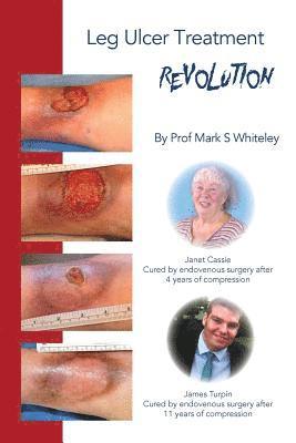 Mark Whiteley - Leg Ulcer Treatment Revolution, Häftad