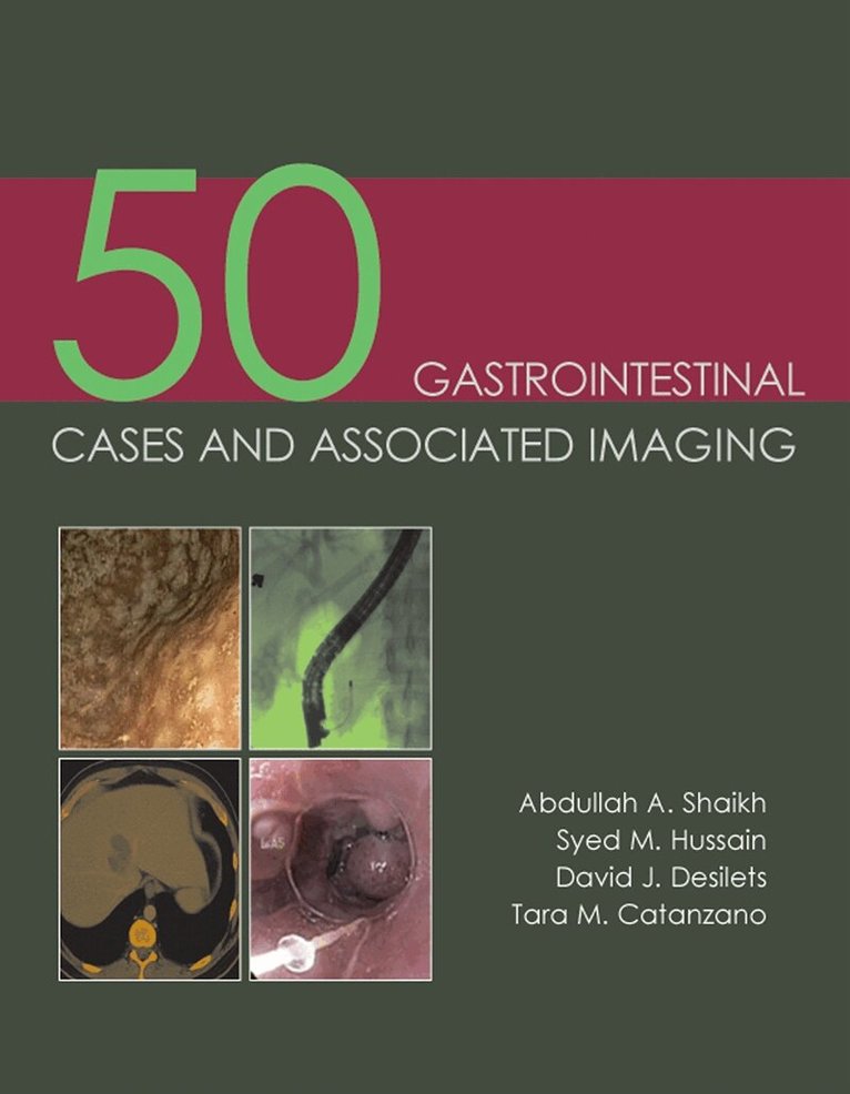 Abdullah A. Shaikh, Syed M. Hussain, David J. Desilets, Tara M. Catanzano - 50 Gastrointestinal Cases and Associated Imaging, E-bok