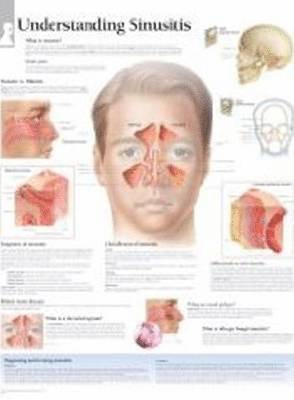 Scientific Publishing - Understanding Sinusitis Laminated Poster, Övrigt