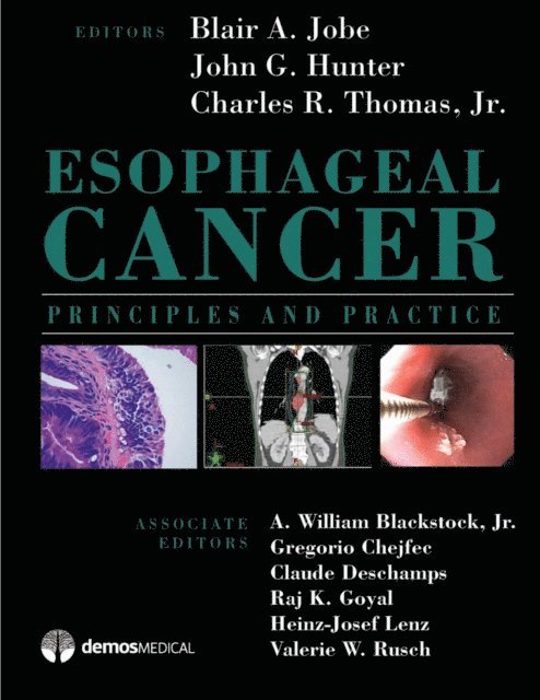 MD Blair A. Jobe, MD John G. Hunter, MD Thomas R. Charles - Esophageal Cancer, E-bok