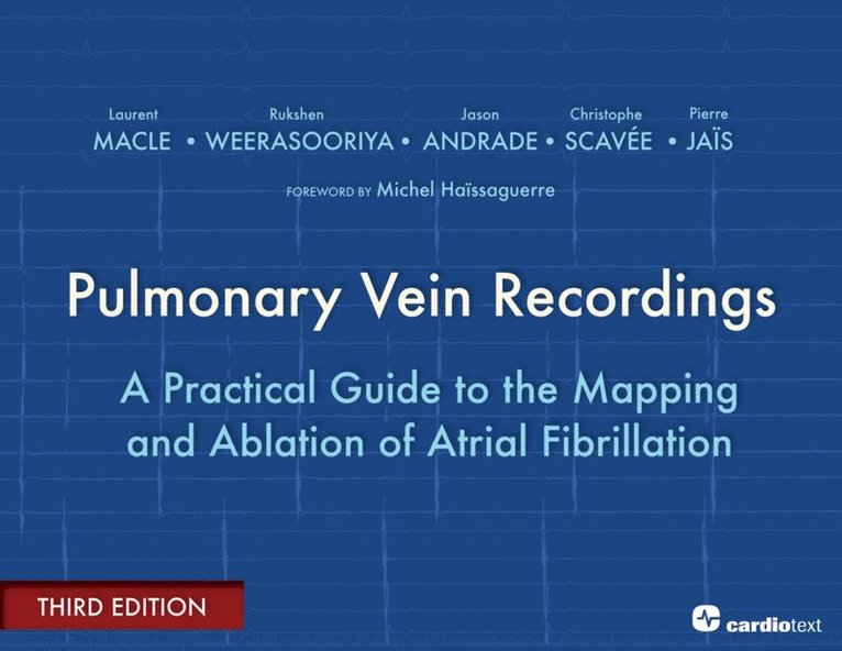 Jason Andrade, Rukshen WEERASOORIYA, Laurent Macle - Pulmonary Vein Recordings : A Practical Guide to the Mapping and Ablation of Atrial Fibrillation Vol 3, E-bok