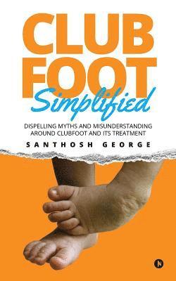 Santhosh George - Clubfoot Simplified: Dispelling Myths and Misunderstanding around Clubfoot and its treatment, Häftad