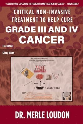 Merle Loudon - Critical Non-Invasive Treatment to Cure Grade III and IV Cancer, Häftad