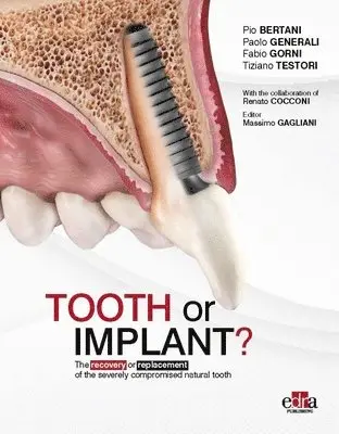 Paolo Generali, Fabio Gorni, Tiziano Testori - Tooth or Implant, Inbunden. Tillgänglighet: Lägg i varukorg