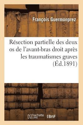 Guermonprez-F - Résection partielle des deux os de l'avant-bras droit après les traumatismes graves, Häftad. Tillgänglighet: Lägg i varukorg