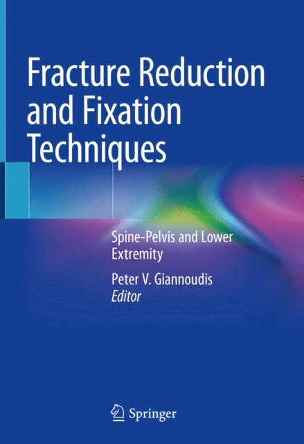 Peter V. Giannoudis - Fracture Reduction and Fixation Techniques, E-bok