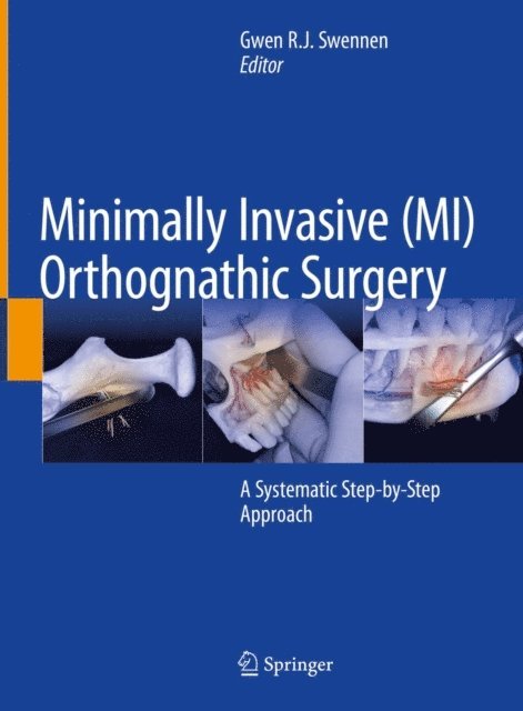 Gwen R.J. Swennen - Minimally Invasive (MI) Orthognathic Surgery, E-bok