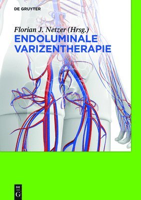 Florian Johannes Netzer - Endoluminale Varizentherapie, Inbunden. Tillgänglighet: Tillfälligt slut