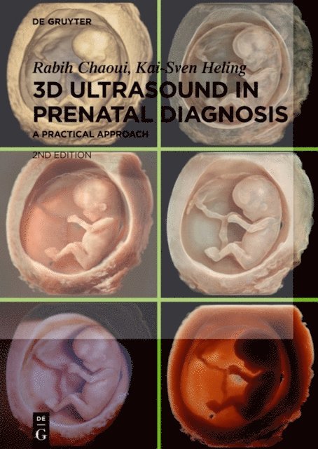 Kai-Sven Heling, Rabih Chaoui - 3D Ultrasound in Prenatal Diagnosis, E-bok