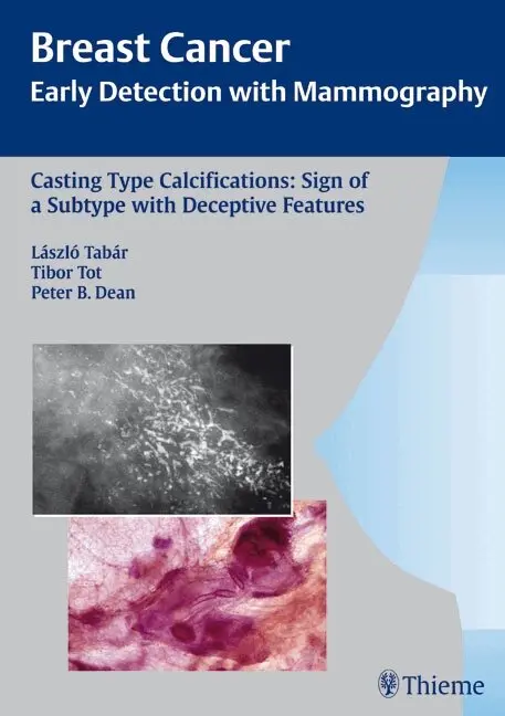 Laszlo Tabar, Tibor Tot, Peter B. Dean - Casting-Type Calcifications: Sign of a Subtype with Deceptive Features, Inbunden. Tillgänglighet: Tillfälligt slut