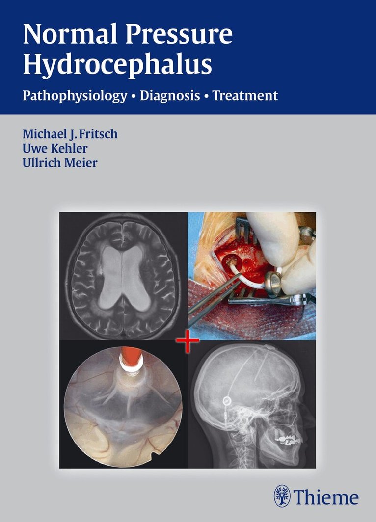 Michael J. Fritsch, Uwe Kehler, Ullrich Meier - NPH - Normal Pressure Hydrocephalus, Inbunden. Tillgänglighet: Lägg i varukorg