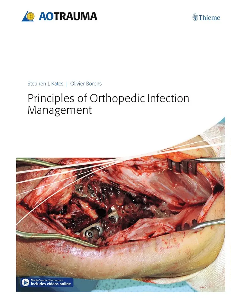 Stephen Kates, Olivier Borens - Principles of Orthopedic Infection Management, Inbunden. Tillgänglighet: Tillfälligt slut