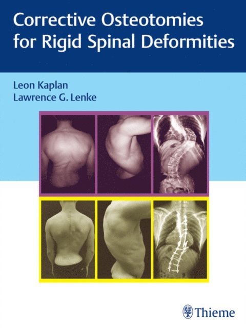 Lawrence G. Lenke, Leon Kaplan - Corrective Osteotomies for Rigid Spinal Deformities, E-bok