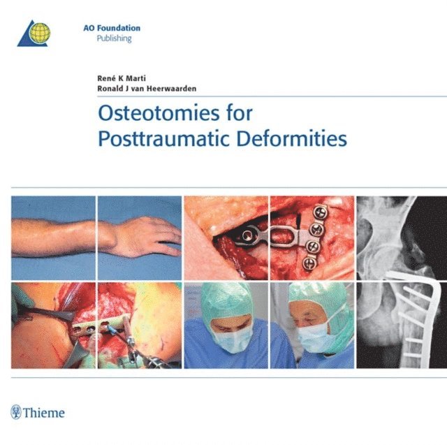 Ronald J. van Heerwaarden, Rene K. Marti - Osteotomies for Posttraumatic Deformities, E-bok