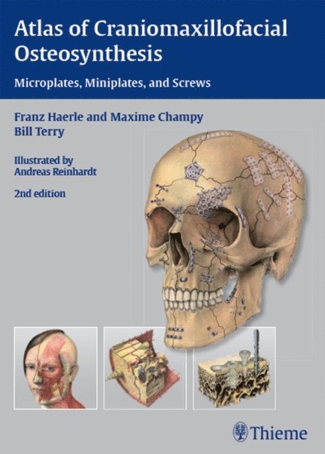 Bill Terry, Maxime Champy, Franz Harle - Atlas of Craniomaxillofacial Osteosynthesis, E-bok. Tillgänglighet: Lägg i varukorg