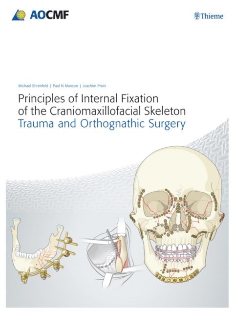 Joachim Prein, Paul N. Manson, Michael Ehrenfeld - Principles of Internal Fixation of the Craniomaxillofacial Skeleton, E-bok