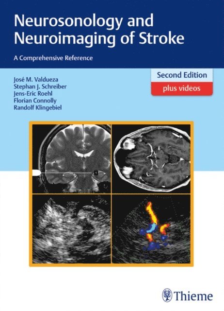 Randolf Klingebiel, Florian Connolly, Jens-Eric Rohl, Stephan Schreiber, Jose Manuel Valdueza - Neurosonology and Neuroimaging of Stroke, E-bok