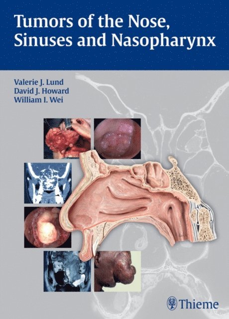 William I. Wei, David Howard, Valerie J. Lund - Tumors of the Nose, Sinuses and Nasopharynx, E-bok