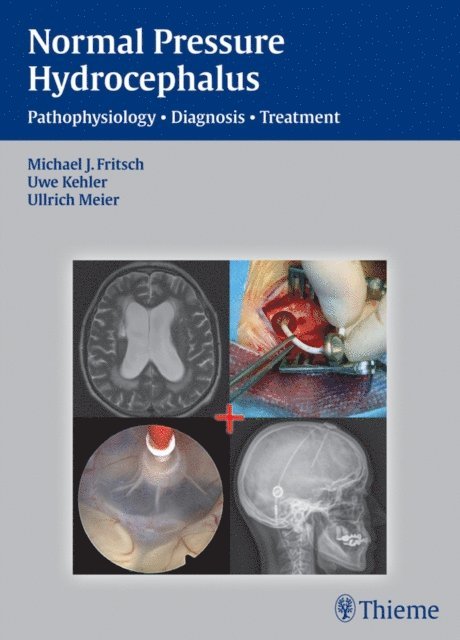 Ullrich Meier, Uwe Kehler, Michael J. Fritsch - Normal Pressure Hydrocephalus, E-bok. Tillgänglighet: Lägg i varukorg