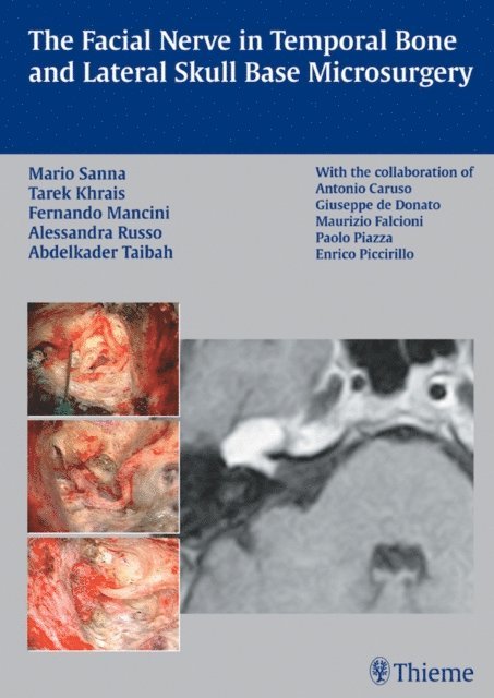 Abdelkader Taibah, Alessandra Russo, Fernando Mancini, Tarek Khrais, Mario Sanna - Facial Nerve in Temporal Bone and Lateral Skull Base Microsurgery, E-bok