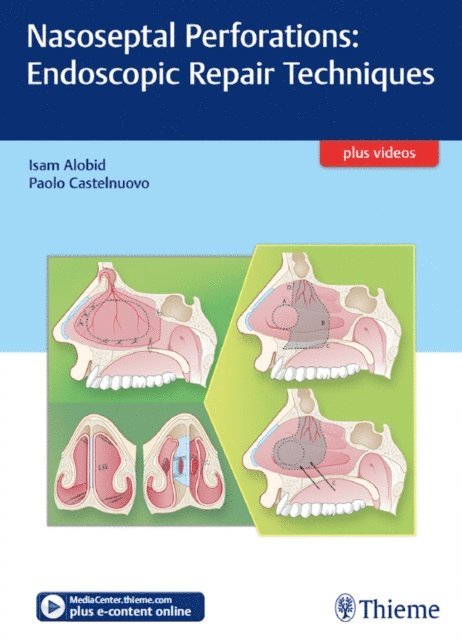 Paolo Castelnuovo, Isam Alobid - Nasoseptal Perforations: Endoscopic Repair Techniques, E-bok