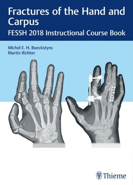 Martin Richter, Michel E.H. Boeckstyns - Fractures of the Hand and Carpus, E-bok