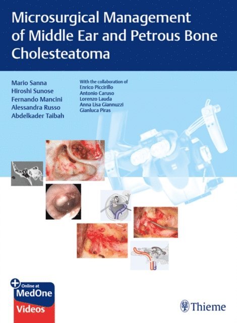 Abdelkader Taibah, Alessandra Russo, Fernando Mancini, Hiroshi Sunose, Mario Sanna - Microsurgical Management of Middle Ear and Petrous Bone Cholesteatoma, E-bok